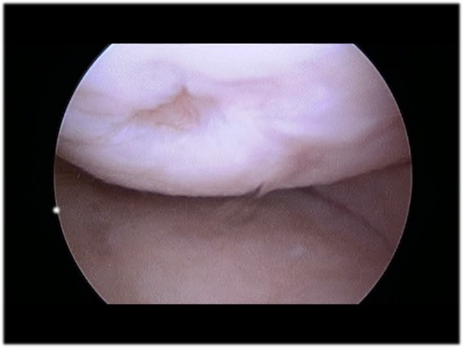 Treating Articular Cartilage Defects in the Knee SHELBOURNE KNEE CENTER